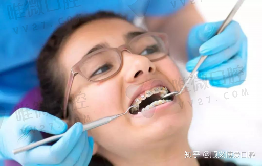 牙隐裂和龋齿的区别（牙隐裂严重吗）常见问题解读！